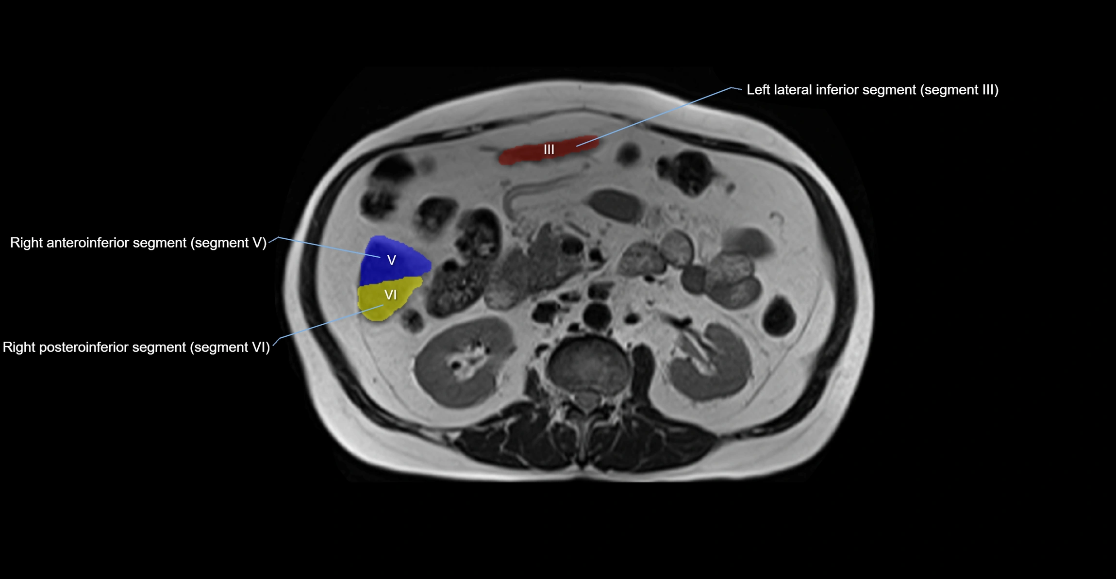 MRI  liver segments anatomy axial cross sectional 3T radiology  image-img-00001-00022.webp